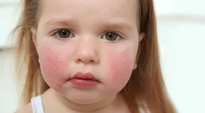 У ребёнка аллергия на картофель. Как быть? | Мама двойняшек | Дзен
