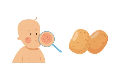 Аллергия на картошку: что делать, если вы столкнулись с этой проблемой -  Медправда