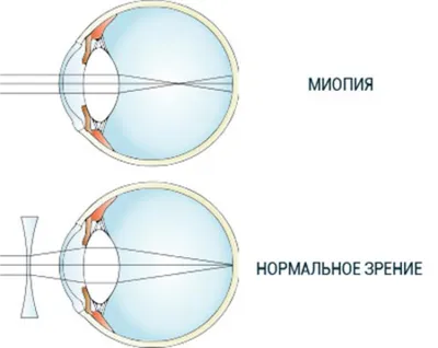 Как сберечь зрение детей — Газета «Калужская неделя»