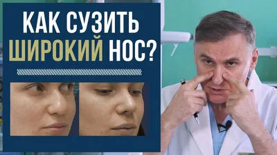 Пластика носа (ринопластика): стоит ли делать? - Клиника в Уручье