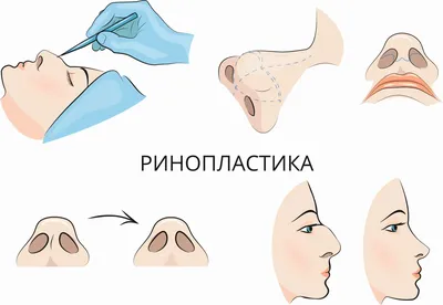 Безоперационная ринопластика: о процедуре, фото до и после, сколько стоит |  Сеть клиник ЛИНЛАЙН в Москве, Екатеринбурге, Воронеже, Краснодаре