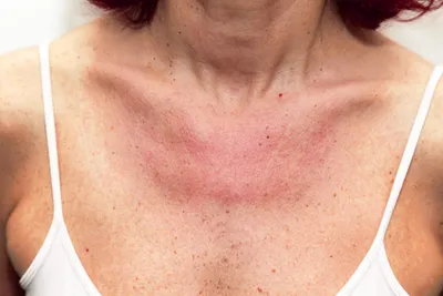 Аллергия на солнце. Как защитить кожу и что делать, если она уже пострадала?