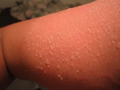 Аллергия на солнце: она же фотодерматит