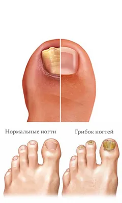 Псориаз ногтей: причины, симптомы, как проявляется, что делать, лечение