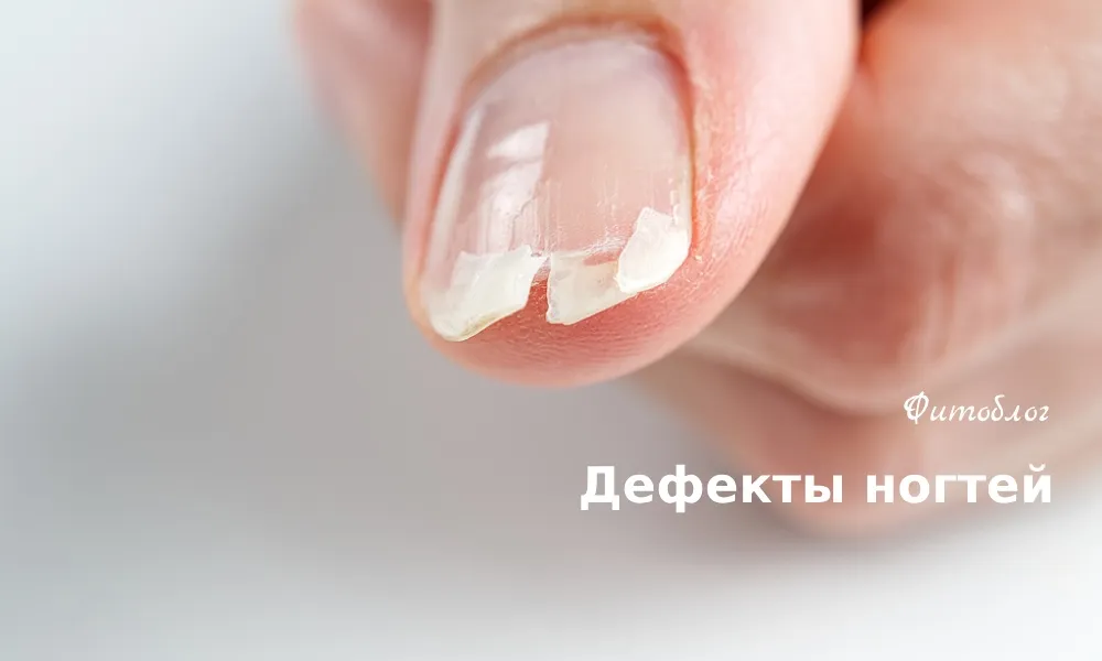 Гиперкератоз ногтей