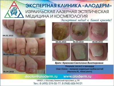 Пустота под ногтем ? Как лечить? | Nail Master | Дзен