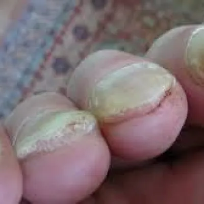 Дерматолог объяснила, как по ногтям определить проблемы со здоровьем