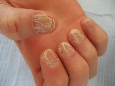 Причины изменения цвета ногтей и методы устранения дефекта