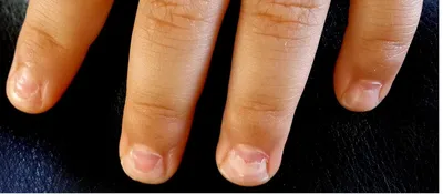 О каких заболеваниях говорят ногти на руках и ногах, как по цвету ногтей  определить болезнь - Чемпионат