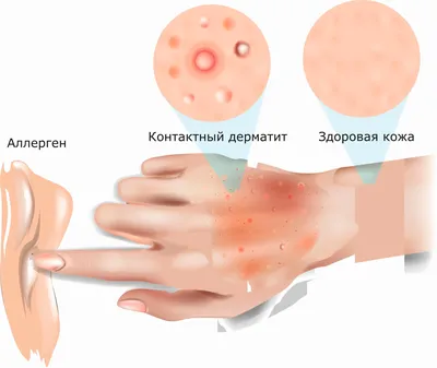 Аллергический контактный дерматит - лечение, клинические рекомендации,  причины