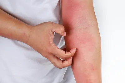 женщина чесать зуд рука понятие атопический дерматит красные руки  дерматологическая проблема Стоковое Фото - изображение насчитывающей люди,  аллергических: 221136220