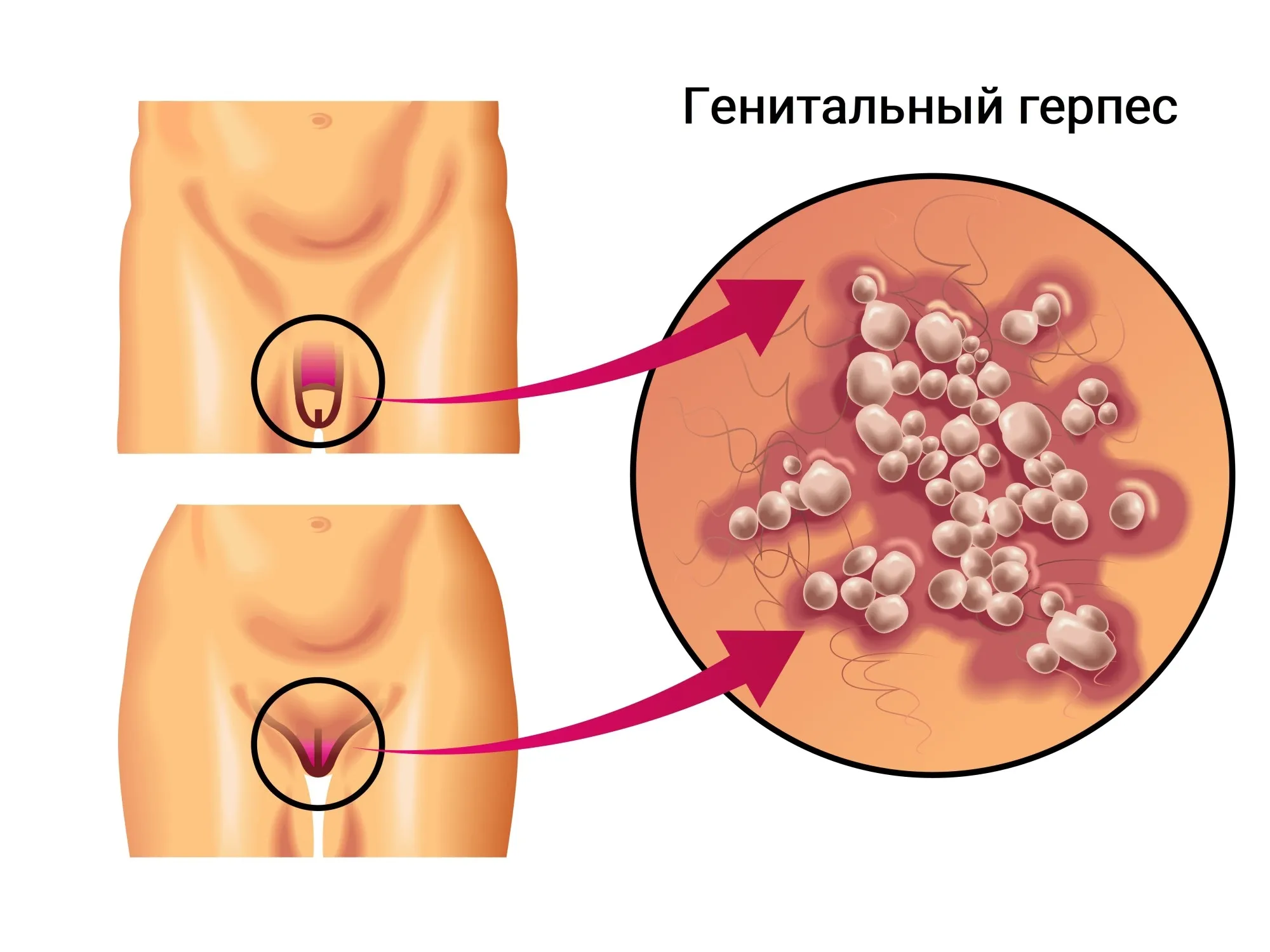 5 причин появления уплотнений в области вульвы