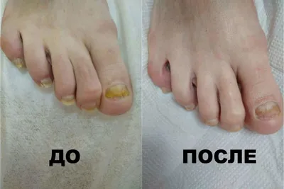 Foot Fungus Treatment | Toenail Fungus Care - Nailyuba