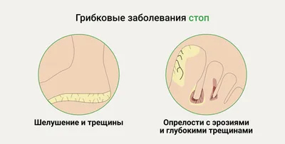 Грибок ногтей на ногах и руках: причины, первые признаки, основные  симптомы. Лечение онихомикоза в Москве