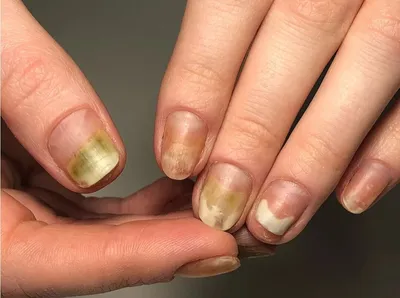 Лечение грибка ногтей в Санкт-Петербурге лазером