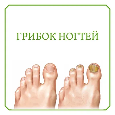 Грибок ногтей — Derma.ua