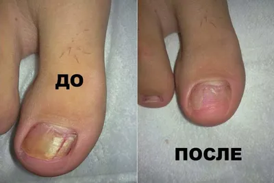 Медицинский педикюр при грибке ногтей | Где в Москве сделать чистку  грибковых ногтей