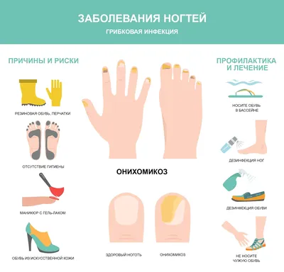 Эффективное лечение грибка ногтей - meds.ru
