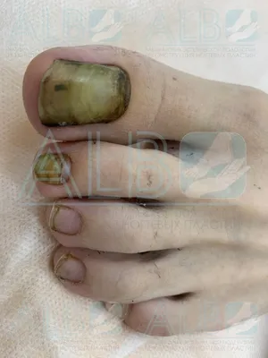 Чистка ногтей пораженныx грибковой инфекцией в Красногорске, цена у подолога