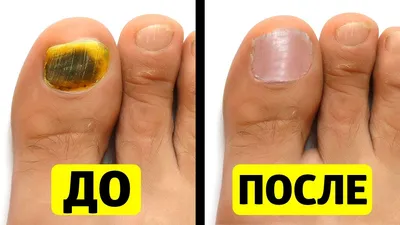 Лечение онихомикоза ногтей — лечение грибка ногтей в Красноярске