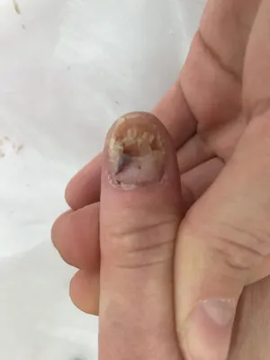 Лечение застарелого грибка ногтей | Клиника АЛОДЕРМ , Москва