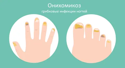 Лечение запущенной формы грибка ногтей, признаки застарелого онихомикоза