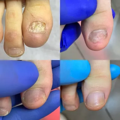Грибок ногтей | Журнал Доктора Комаровського