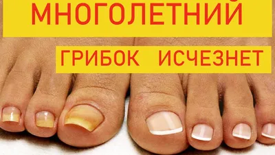 Лечение грибка ногтей в Москве | цены в клиниках «МедлайН-Сервис»