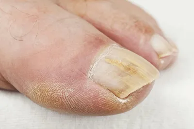 🦠Грибок ногтей или «онихомикоз» относится к заболеваниям, которые способны  полностью разрушить ногтевую пластину🙊 .. | ВКонтакте