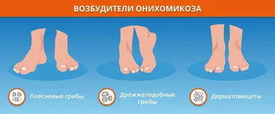 Грибок ногтей (онихомикоз) лечение и профилактика.