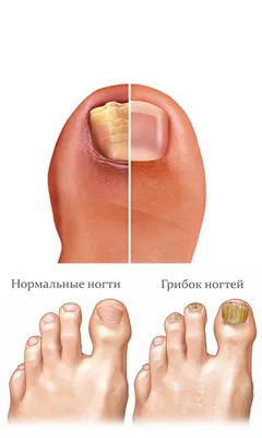 Грибковые заболевания ногтей: Поражение околоногтевых тканей и ногтевых  пластинок