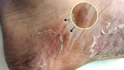 Грибок стопы – одно из самых частых грибковых поражений кожи. Зачастую  инфицируется кожа между пальцами и нижняя поверхность стопы.… | Instagram