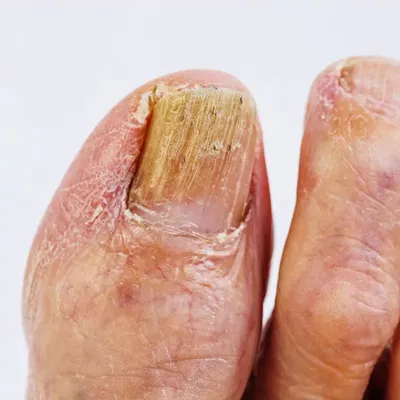 Onychomycosis и сухая кожа на пятки женской ноги. Вызванный грибок кандиды  зудящ отслаивание красноты неудач кожи Стоковое Изображение - изображение  насчитывающей пятка, заболевание: 179743967