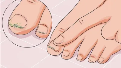Как лечить грибок на ногах в домашних условиях: подборка эффективных  способов