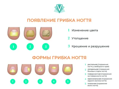 Сухие Руки Кожура Контактный Дерматит Грибковые Инфекции Инф Кожи —  стоковые фотографии и другие картинки Аллергия - iStock