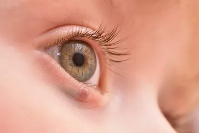 Ячмень на глазу: как лечить в домашних условиях | Глаза, Медицинские  цитаты, Ячмень