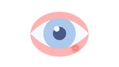 Ячмень на глазу: почему появляется и как предотвратить воспаление — Блог  компании \"Культура зрения\"