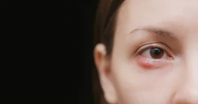 Антибиотик ОАО \"Татхимфармпрепараты\" Тетрациклиновая мазь глазная 1% - «Как  лечить ячмень на глазу? Тетрациклиновая мазь антибактериальная» | отзывы