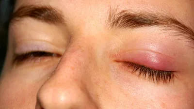 Офтальмолог объяснила, почему выскакивает ячмень на глазу и как его  вылечить | Эксимер, офтальмологическая клиника | Дзен