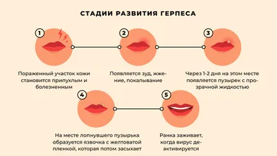 Как избавиться от герпеса на губах: народные методы - Здоровье 24