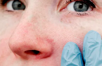 Купероз на лице: причины и лечение, как бороться и избавиться от купероза