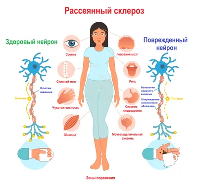 G35 Рассеянный склероз | Описание болезни, диагностика, лечение