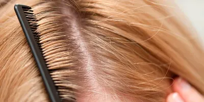 Безопасное лечение волос против клещей шампунь от перхоти серы эффективный  уход за кожей головы бальзам удаление вшей для дома | AliExpress