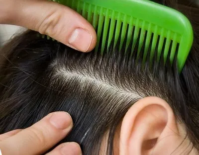 Педикулез волосистой части головы, или вшивость - причины появления,  симптомы заболевания, диагностика и способы лечения