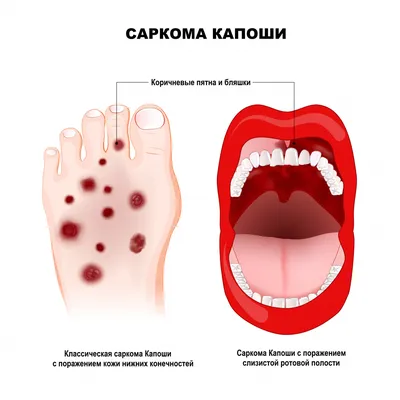 Метастазы в лимфоузлах | Прогноз, лечение | Клиника НАКФФ в Москве