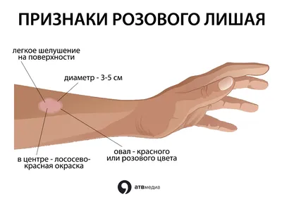 Можно ли вылечить лишай у ребенка — советы в блоге ОН Клиник