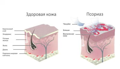 Экзема на лице: лечение народными средствами, фото, причины возникновения,  как она выглядит на коже у женщин