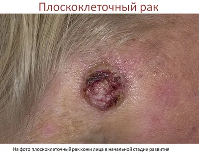 Рак кожи на лице картинки фотографии