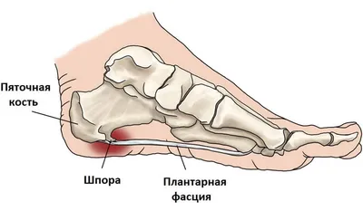 Пяточные шпоры | Клиника Стариша