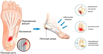 Пяточная шпора (плантарный фасциит): симптомы и лечение